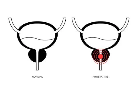 Prostatitis inflammation problem Illustrazione stock