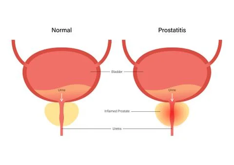 Prostatitis inflammation problem Illustrazione stock