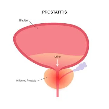 Prostatitis inflammation problem Illustrazione stock