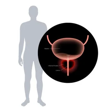 Prostatitis inflammation problem Illustrazione stock