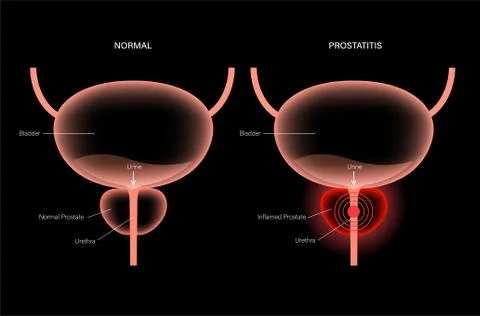 Prostatitis inflammation problem Illustrazione stock