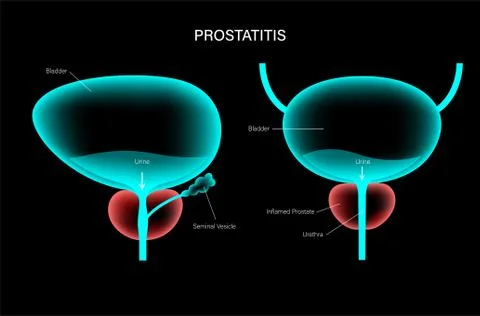 Prostatitis inflammation problem Illustrazione stock