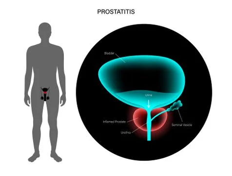 Prostatitis inflammation problem Stock Illustration