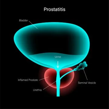 Prostatitis inflammation problem Illustrazione stock