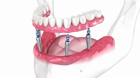 Prostheses supported by 4 implants. Dental 3D animation Stock Footage 239234375