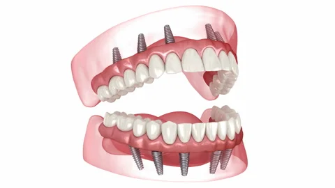 Prostheses supported by 6 implants. Dental 3D animation Stock Footage 236838750