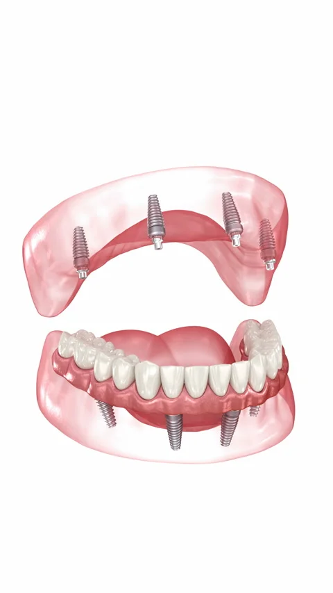 Prostheses supported by 8 implants. Dental 3D animation Stock Footage 259811523