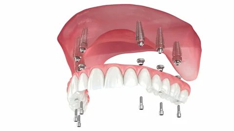 Prostheses supported by six implants. 3D animation Stock Footage 236838679