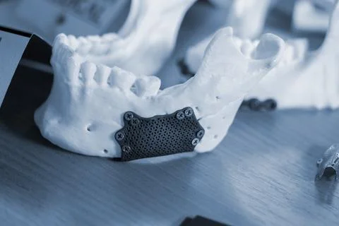 Prototype lower human jaw with medical titanium implant Stock Photos