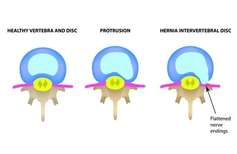 Protrusion of the intervertebral disc. Hernia. Vector illustration on isolated Stock Illustration
