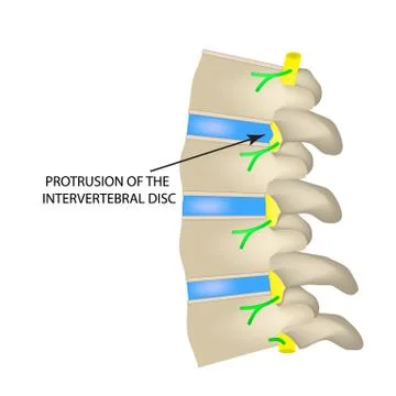 Protrusion of the intervertebral disc. Vector illustration on isolated Stock Illustration
