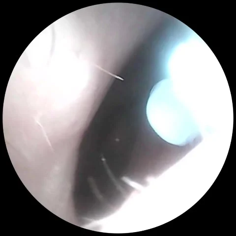 Prurigo nodularis within nostril 動画素材 320642303