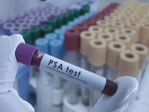 PSA blood test Stock Photos