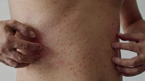 Psoriasis is the abdomen on white background. Stock Footage 202624275