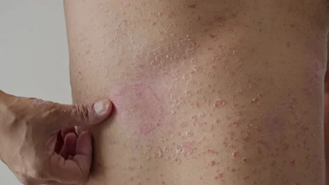 Psoriasis is the abdomen on white background. Stock Footage 202624366