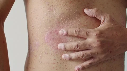 Psoriasis is the abdomen on white background. Stock Footage 202624687