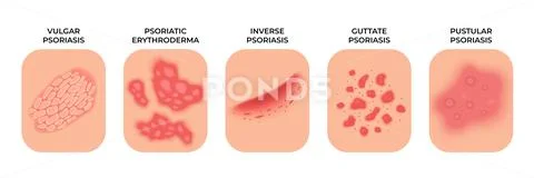Psoriasis. Allergic eczema types, rashes treatment. Dermatology ...