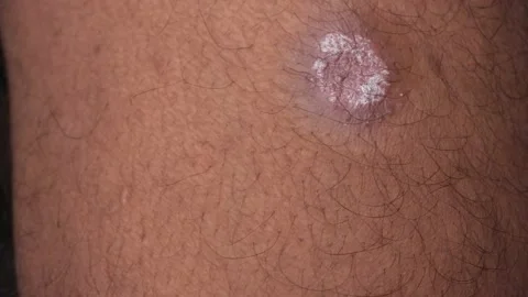 Psoriasis- Autoimmune disese wound Stock Footage 157919232