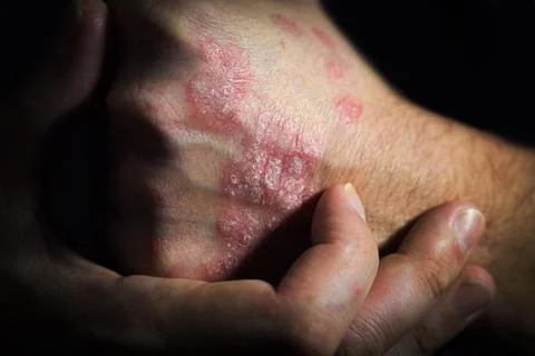Psoriasis is an autoimmune human disease. a man holds a hand at a psoriasis Stock Photos