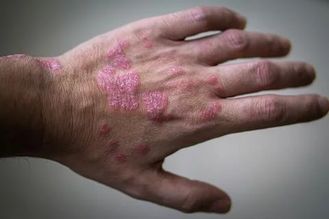 Psoriasis. autoimmune skin disease. man's hand with pockets of psoriasis lesion Stock Photos