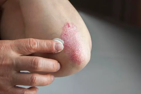 Psoriasis on elbow Stock Photos