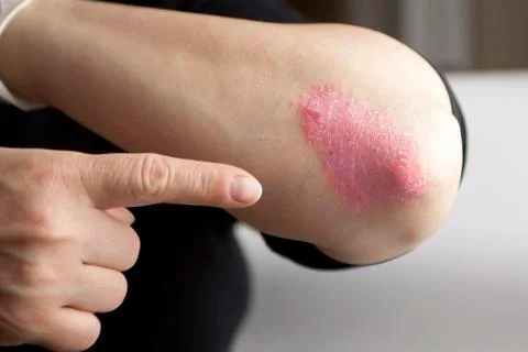 Psoriasis on elbow Stock Photos