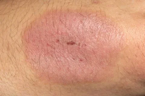 Psoriasis Elbow Stock Photos