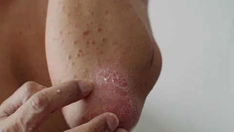 Psoriasis is that elbow on white background. Stock Footage 202624356