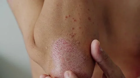 Psoriasis is that elbow on white background. Stock Footage 202624709