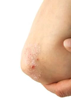 Psoriasis on elbows Stock Photos