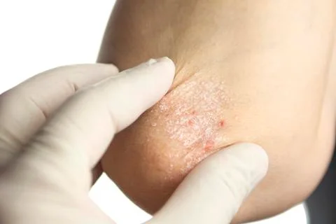 Psoriasis on elbows Stock Photos