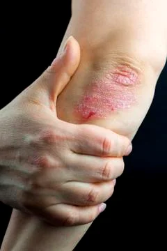 Psoriasis on elbows Stock Photos