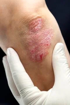 Psoriasis on elbows Foto stock