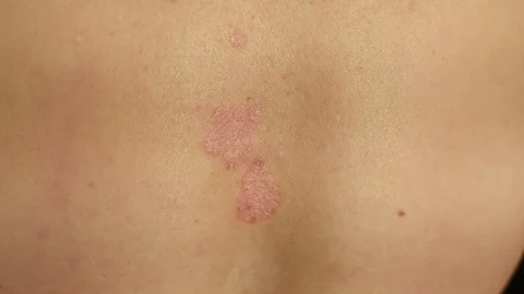 Psoriasis Video stock 104930688