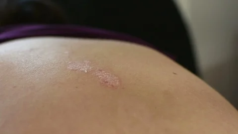 Psoriasis Stock Footage 104930731