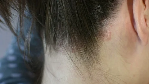 Psoriasis 動画素材 104930866