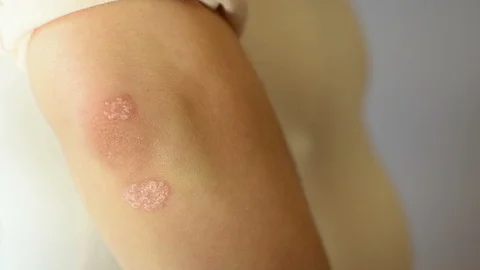 Psoriasis 動画素材 104931067