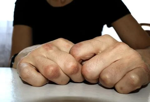 Psoriasis on hands 库存照片