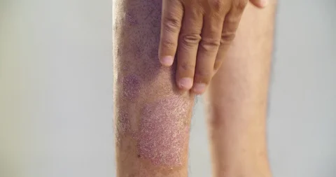 Psoriasis that knee on gray background. 4K Video stock 109199709