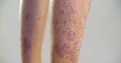 Psoriasis that knee on gray background. 4K Stock Footage 109199866