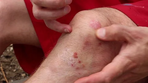 Psoriasis on the knees Stock Footage 76119279