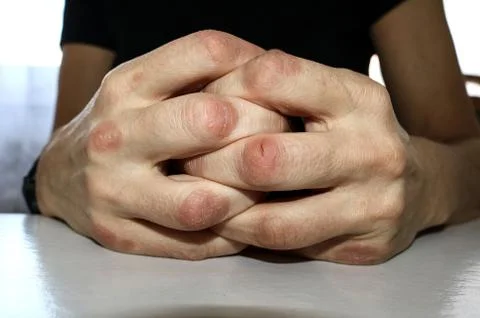 Psoriasis knuckles 库存照片