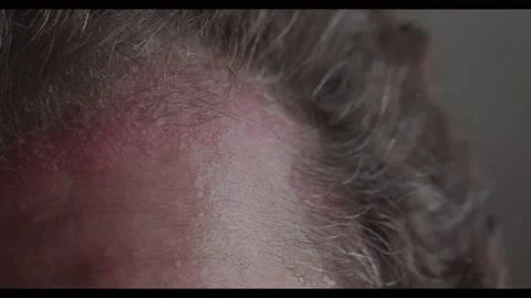 Psoriasis on man's scalp Stock Footage 135899427