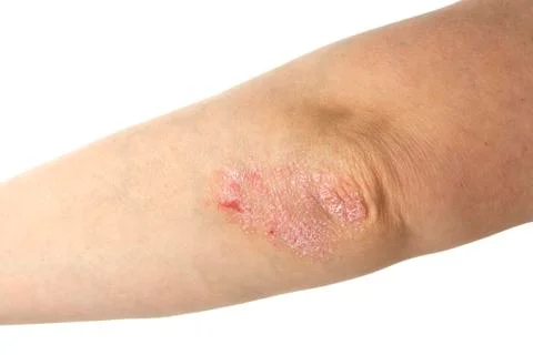 Psoriasis Stock Photos