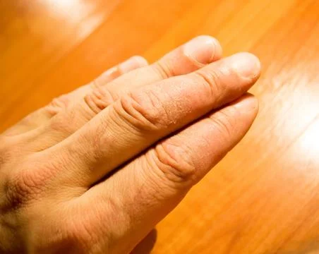 Psoriasis . Stock Photos