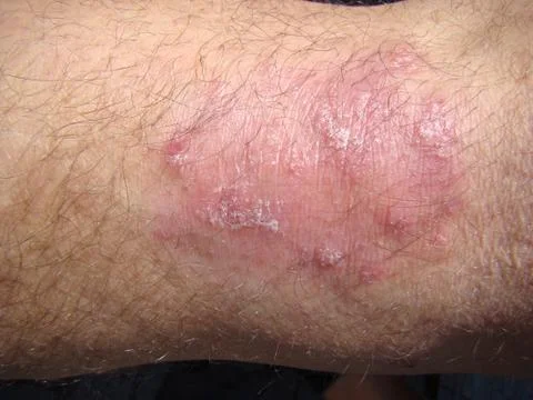 Psoriasis Stock Photos