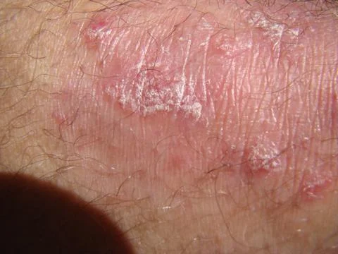 Psoriasis Stock Photos