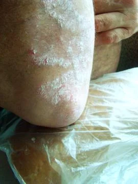 Psoriasis Stock Photos