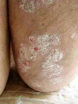 Psoriasis Stock Photos