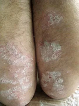 Psoriasis Stock Photos